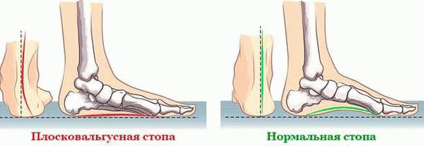  Что такое плоскостопие и как его определить 