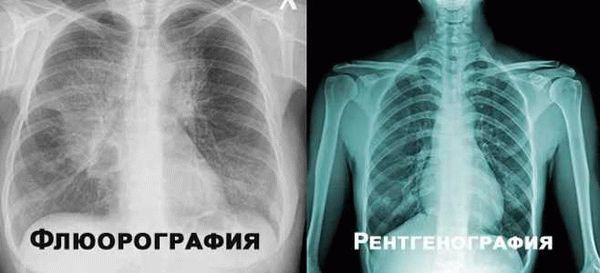 Периодичность прохождения флюорографии